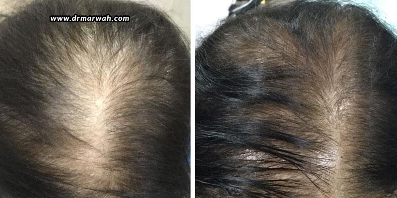 PRP – A Promising New Means To Re-Grow Your Mane