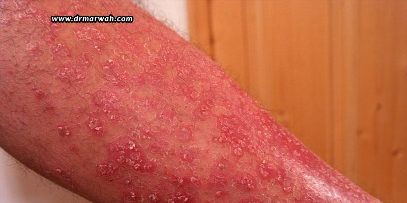 Psoriasis – Symptoms, Causes & Treatments