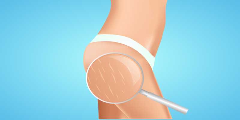 VBeam for Stretch Marks