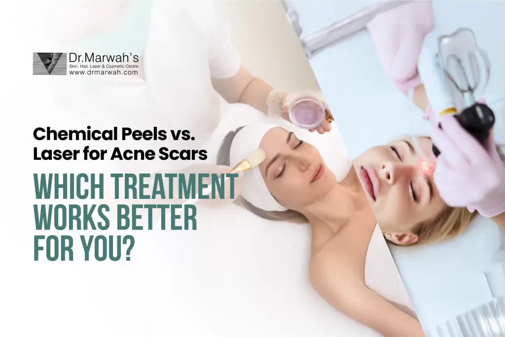 Chemical Peels vs. Laser for Acne Scars: Which Treatment Works Better for You?