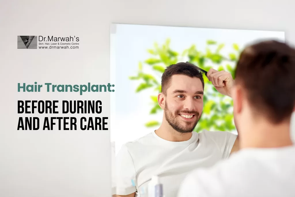 Hair Transplant: Before, During, and After Care
