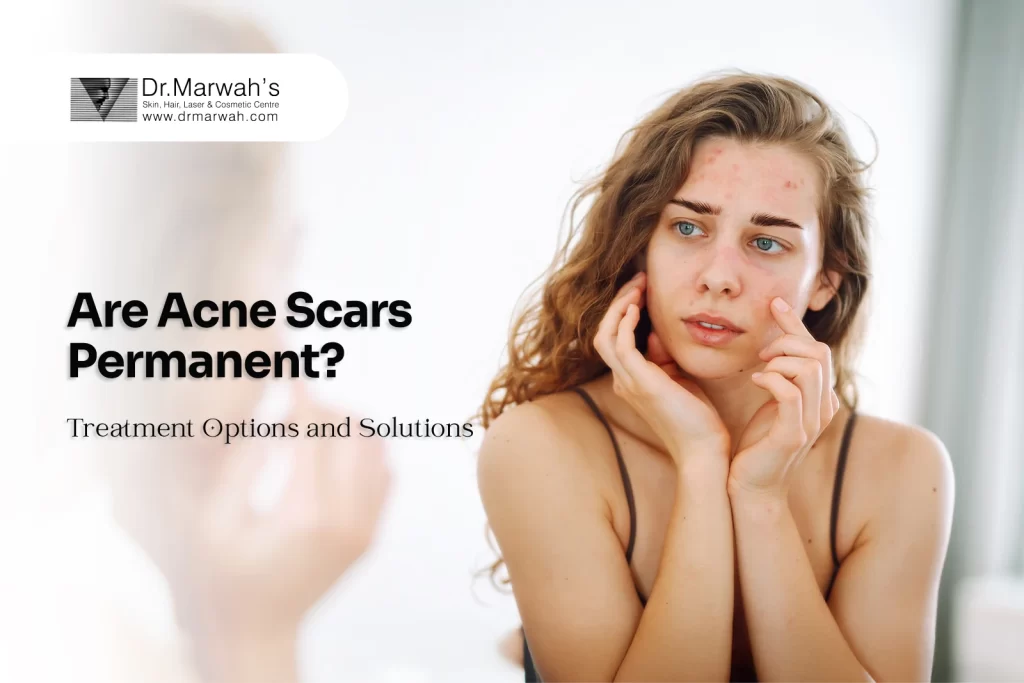 Are Acne Scars Permanent? Treatment Options and Solutions
