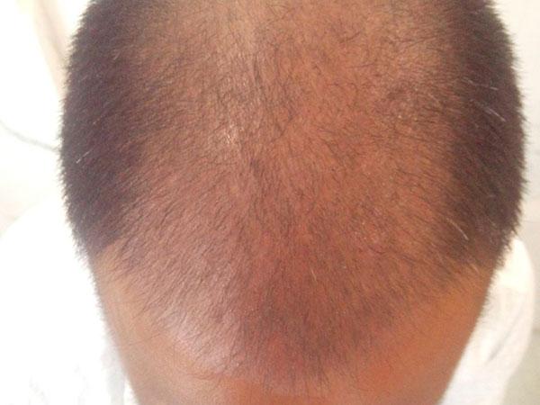 Hair Transplant Before Treatment