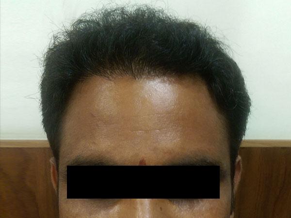 Hair Transplant After Treatment