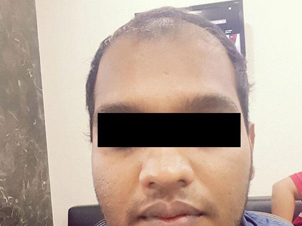 Hair Transplant Before Treatment