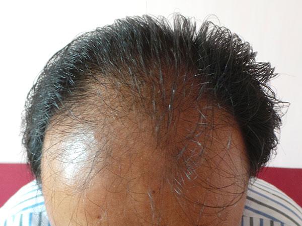 Hair Transplant Before Treatment