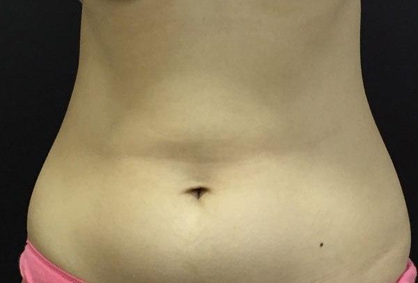 Body Coolsculpting After Treatment