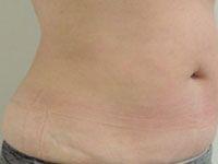 Body UltraShape After Treatment