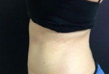 Body Coolsculpting After Treatment