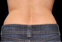 Body Coolsculpting After Treatment