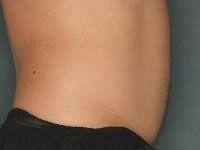 Body UltraShape After Treatment