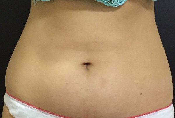Body Coolsculpting Before Treatment