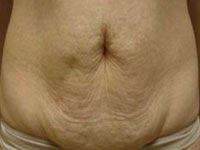 Body UltraShape Before Treatment