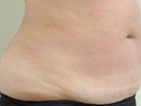 Body UltraShape Before Treatment