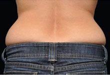 Body Coolsculpting Before Treatment