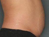 Body UltraShape Before Treatment