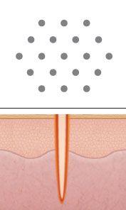 Laser Peel & Acne Scar Treatment