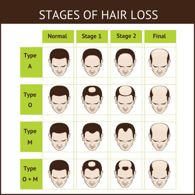 Stages of Hair Loss