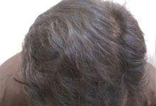 Hair Transplant After Treatment