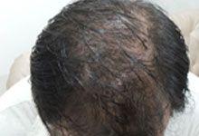 Hair Transplant Before Treatment