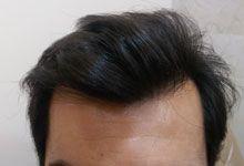Hair Transplant After Treatment