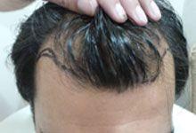 Hair Transplant Before Treatment