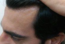 Hair Transplant After Treatment