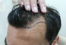 Hair Transplant Before Treatment