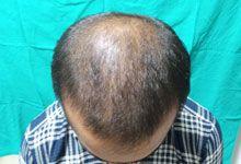 Hair Transplant After Treatment