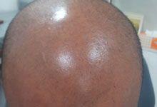 Hair Transplant Before Treatment