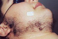 Before Hair Removal Laser Treatment