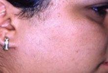After Hair Removal Laser Treatment