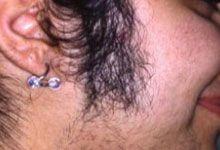 Before Hair Removal Laser Treatment