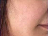 After Laser Peel & Acne Scar Treatment