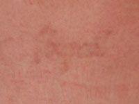 Laser Tattoo Removal Treatment