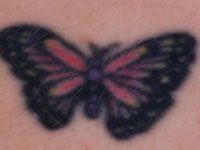 Laser Tattoo Removal Treatment