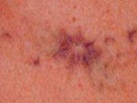 Laser Tattoo Removal Treatment