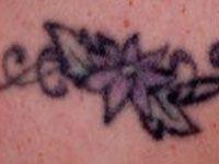 Laser Tattoo Removal Treatment