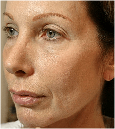 After Thermage Skin Tightening Treatment