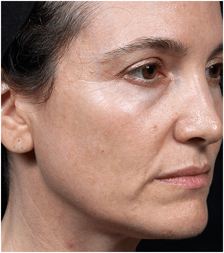 After Thermage Skin Tightening Treatment