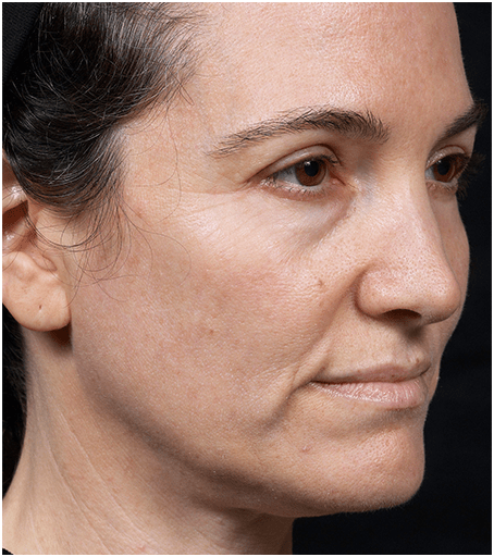 Before Thermage Skin Tightening Treatment