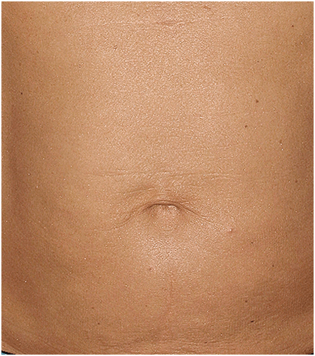 After Thermage Skin Tightening Treatment