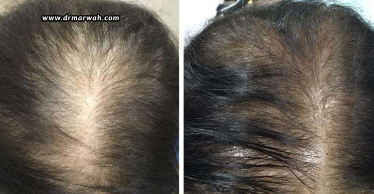 PRP For Hair Loss – Before And After - Dr Marwah's Clinic