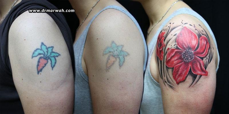 Tattoo Removal – All You Need To Know