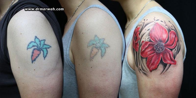 Tattoo-Removal-Will-Picosecond-Lasers-Replace-Nanosecond-Lasers