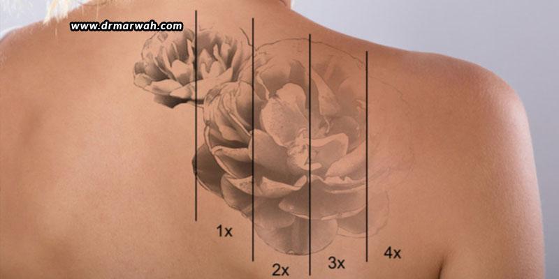 Tattoo Removal – Will Picosecond Lasers Replace Nanosecond Lasers?