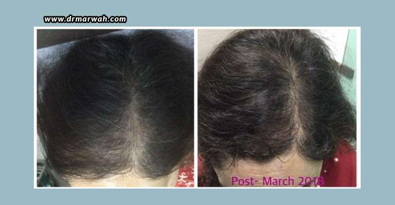 PRP For Hair Loss – Before And After