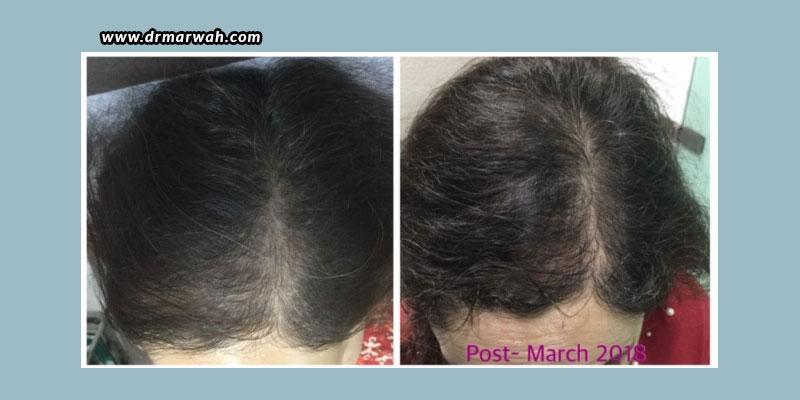 PRP For Hair Loss – Before And After - Dr Marwah's Clinic