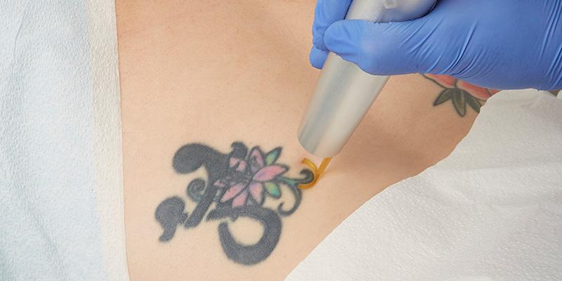 PICOWAY LASER TATTOO REMOVAL - Reborn Aesthetics Clinic