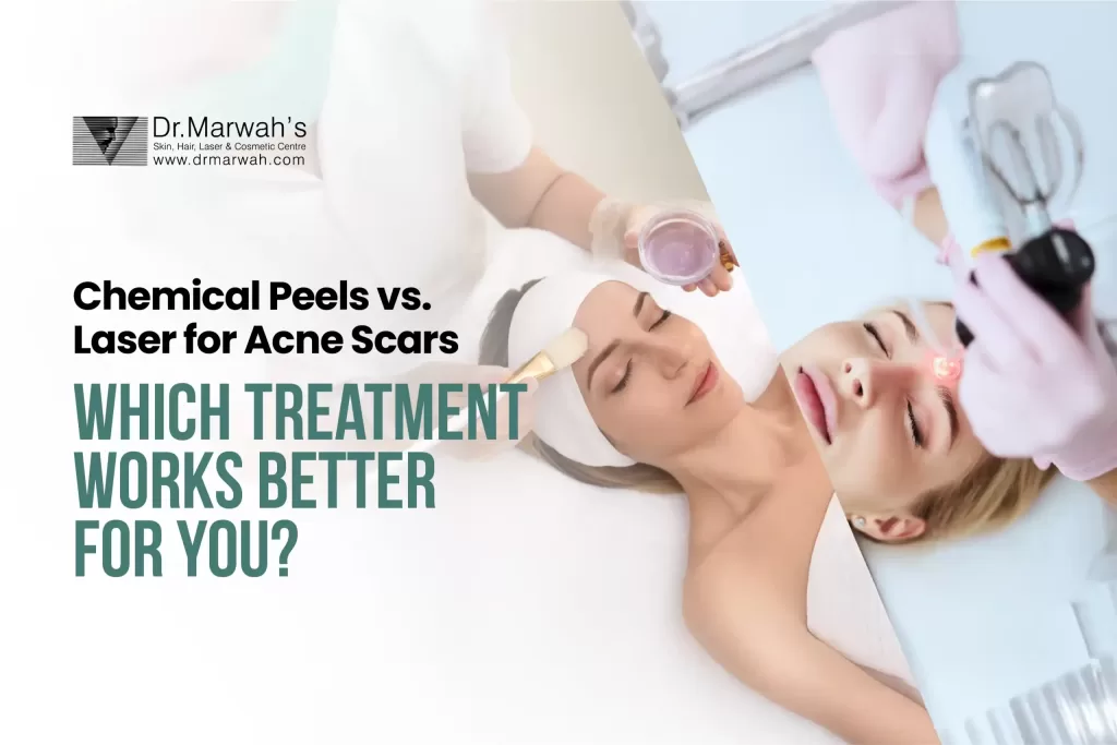 chemical peel vs laser